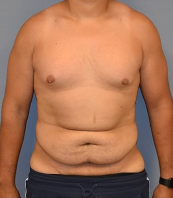 Tummy Tuck for Men Before Patient 1