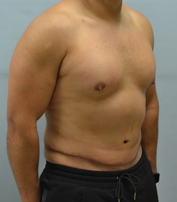 Tummy Tuck for Men After Patient 1