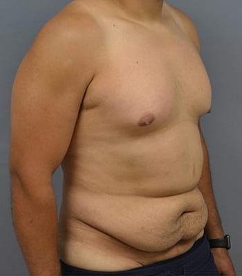 Tummy Tuck for Men Before Patient 1