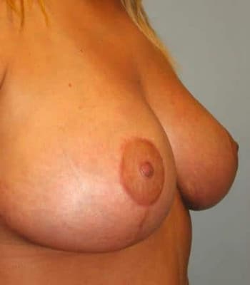 Breast Lift After Patient Thumbnail 2