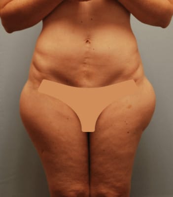 Liposuction Before Patient 1