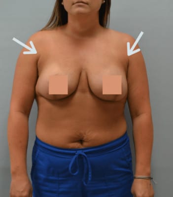 Liposuction After Patient Thumbnail 1