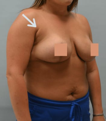 Liposuction After Patient 1