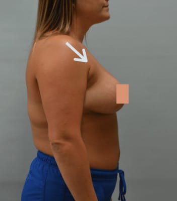 Liposuction After Patient 1