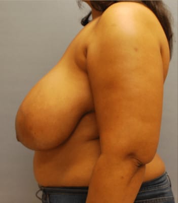 Breast Reduction Before Patient 1