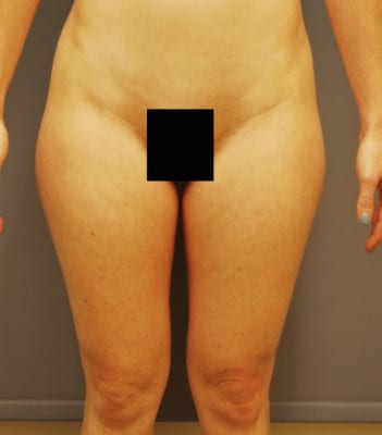 Liposuction Before Patient 1