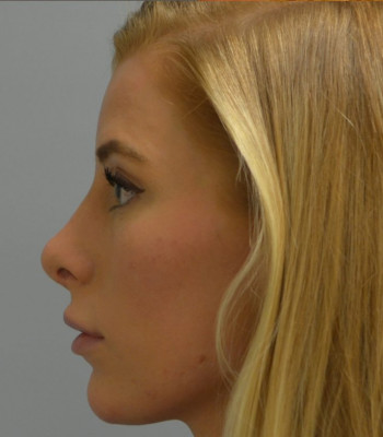 Rhinoplasty After Patient Thumbnail 2