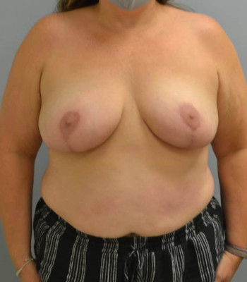Breast Reduction After Patient Thumbnail 1