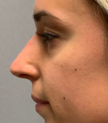 Injectables After Patient 1