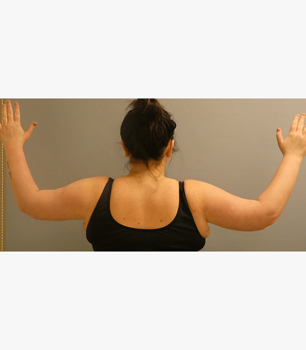 Arm Lift After Patient Thumbnail 3