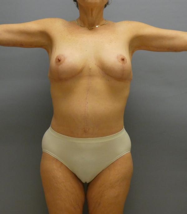 Body Procedures After Patient 58