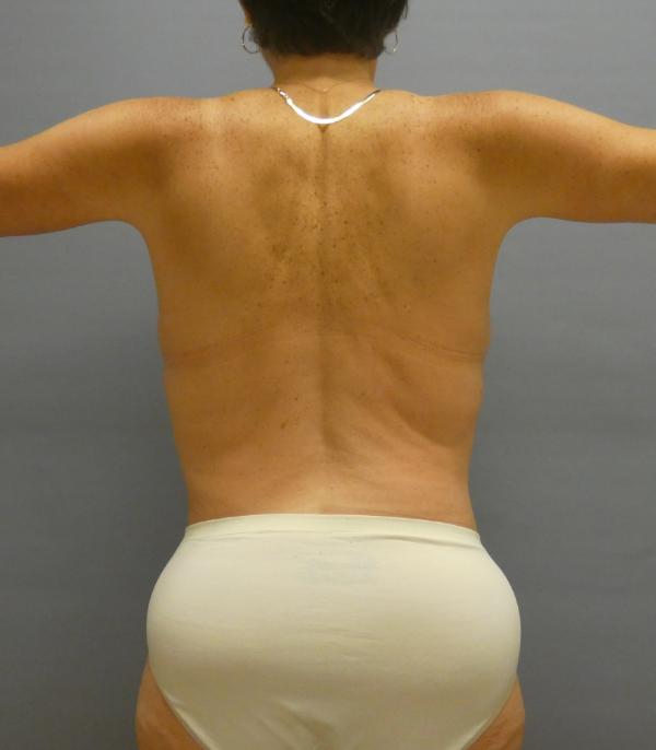 Arm Lift Gallery After Patient 1