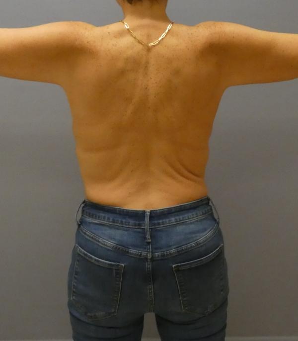 Arm Lift Gallery Before Patient 1