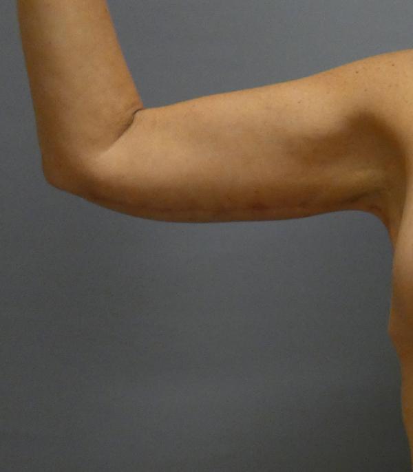 Arm Lift Gallery After Patient 1