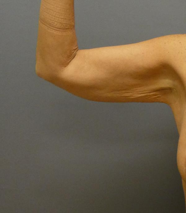 Arm Lift Gallery Before Patient 1