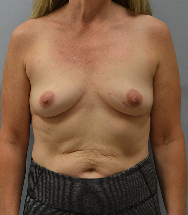 Breast Reconstruction Before Patient Thumbnail 1