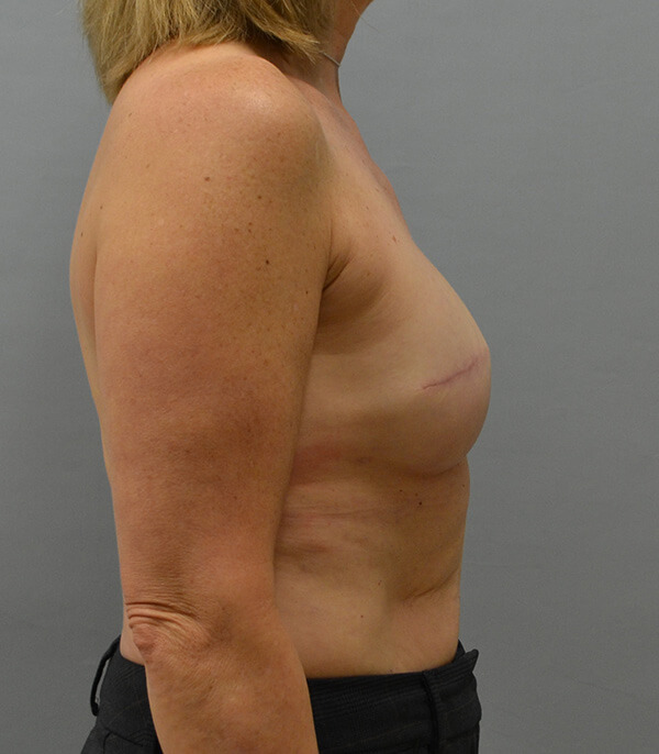 Breast Reconstruction After Patient 1