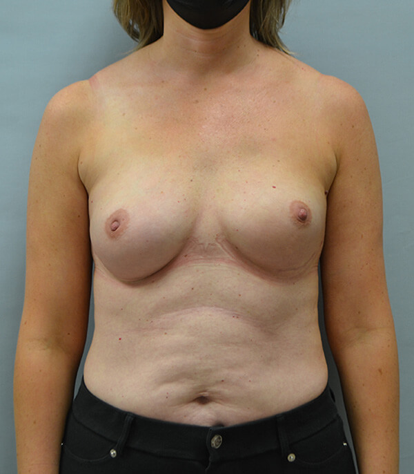 Breast Reconstruction After Patient Thumbnail 1
