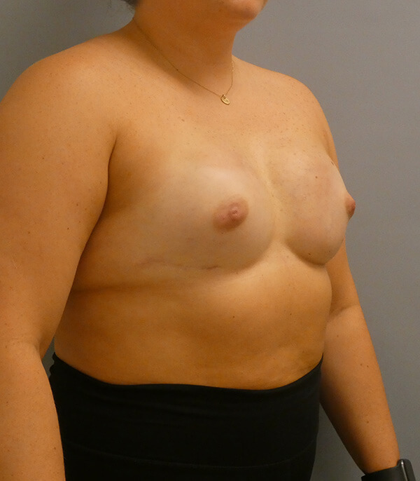 Breast Reconstruction After Patient 1