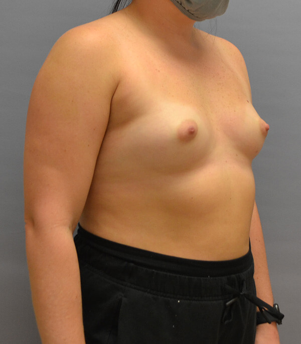 Breast Reconstruction Before Patient 1