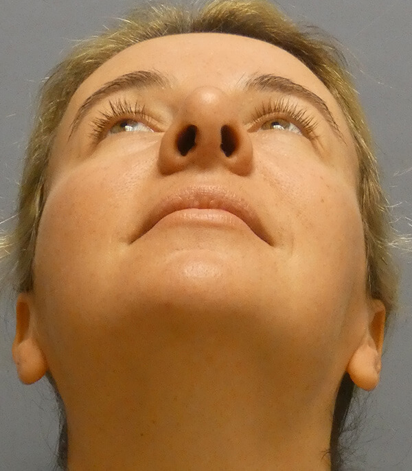 Rhinoplasty After Patient Thumbnail 3