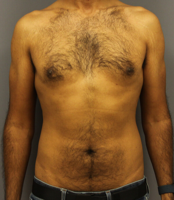 Male Breast Reduction Before Patient 1