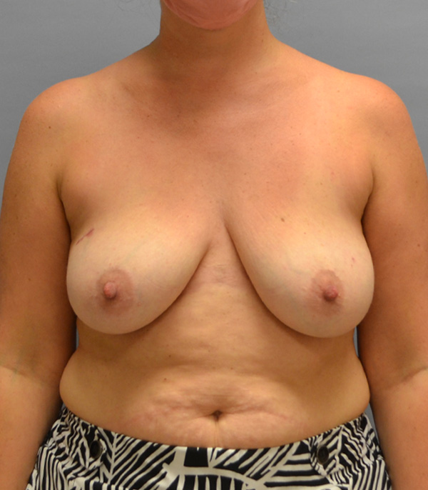 Breast Reconstruction Before Patient Thumbnail 1